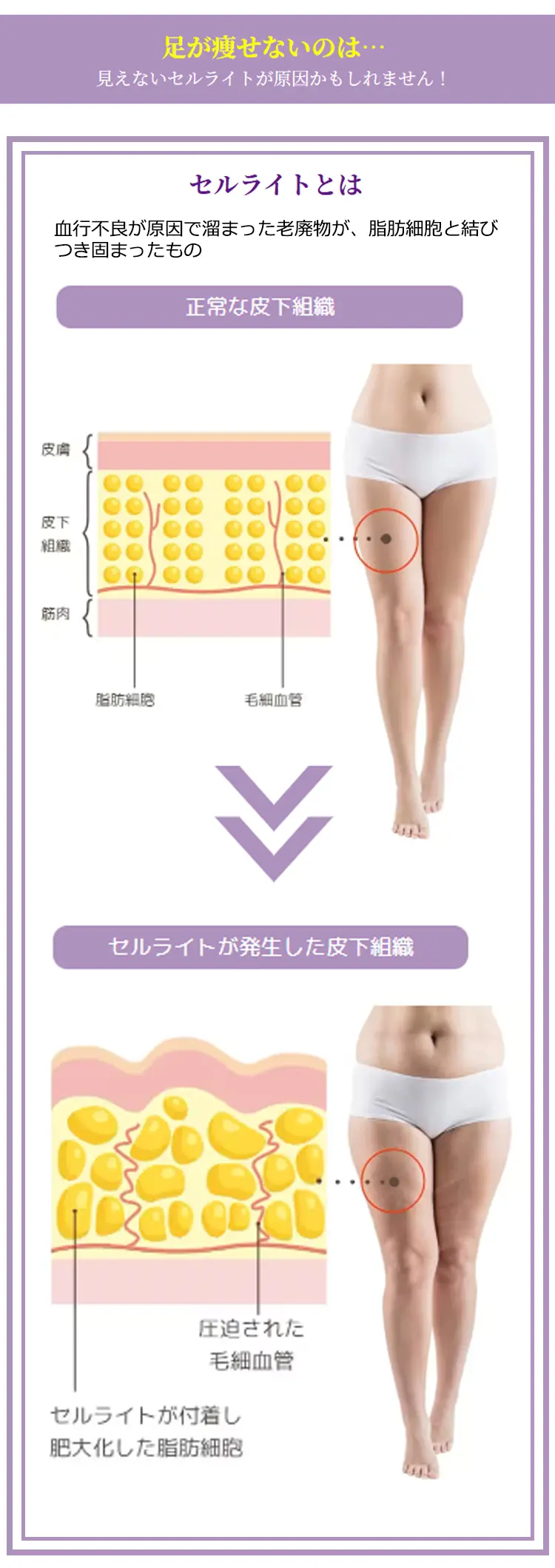 足が瘦せないのは…見えないセルライトが原因かもしれません! セルライトとは 血行不良が原因で溜まった老廃物が、脂肪細胞と結びつき固まったもの
