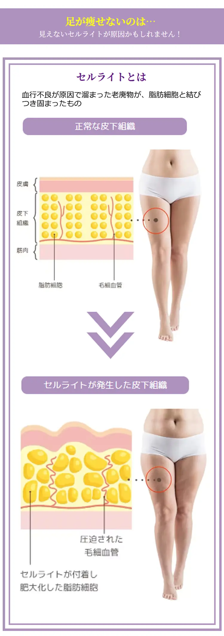 足が瘦せないのは…見えないセルライトが原因かもしれません! セルライトとは、血行不良が原因溜まった老廃物が、脂肪細胞と結びつき固まったもの